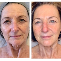 Radiofrequency Skin Tightening in Wrexham: A Relaxing, Non-Invasive Way to Firm and Lift Your Skin